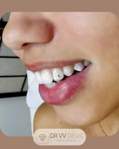 Résultat de pose de strass dentaire réalisée en formation